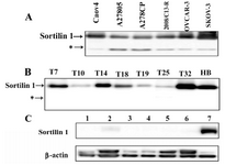 Figure 2. Western blot analysis of sortilin 1 using rabbit polyclonal anti-sortilin antibody under non-reducing conditions. A) All ovarian cancer cell lines exhibited expression of about 100 kDa sortilin 1 protein. *A band of about 50 kDa was also expressed by these cell lines. B) Ovarian cancer tissue samples T7, T10, T14, T18, T19, T25, and T32 corresponding to patients in Table I selected based on their differentiation. Human brain (HB) cell lysate served as positive control. C) Lanes 1-6 representing non-malignant ovarian tissue samples. Lane 7 represents human brain cell lysate. β-actin expression was used as an internal loading control