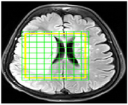 <p>Figure 2. A sample of MRI image in SIVIC software in which the border of the tumor region at the time of imaging is determined as yellow box. Each green tagged square represents a voxel. The amount of each metabolite corresponding to each voxel is extracted in subsequent steps.</p>
