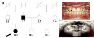 <p>Figure 2. Pedigree of B family. Panoramic radiograph and the clinical photograph of the proband.</p>