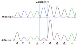 <p>Figure 3. Chromatographs of Sanger sequencing. The healthy parents harbor normal DNA sequences, whereas the patient with CFEOM exhibits a <strong>c.<em>2860C</em>&gt;<em>T</em></strong> mutation at the second nucleotide position of codon 954 (p.Arg954Trp) on exon 21 of the <em>KIF21A</em> gene locus.</p>