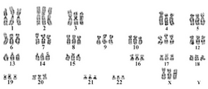 <p>Figure 1. Karyotype result showing 69,XXX.</p>