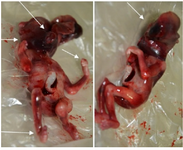 <p>Figure 2. Images of triploid fetus. Arrows show the phenotypes highly associated with triploidy including hydrocephaly, low set ears, bilateral syndactyly of the third and fourth digits and club foot.</p>
