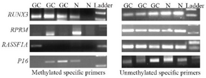 <p>Figure 1. Agarose gel electrophoresis of methylation specific PCR products for <em>RUNX3</em>, <em>RPRM</em>, <em>RASSF1A</em>, and <em>P16</em> in the plasma samples of gastric cancer (GC) patients and the controls (N). Met: Methylated-specific primers; UnMet: Unmethylated-specific primers. <em>RU-NX3</em> Met (115 <em>bp</em>); <em>RUNX3</em> Unmet (115 <em>bp</em>); <em>RPRM </em>Met (120 <em>bp</em>); <em>RPRM </em>Unmet (126 <em>bp</em>); <em>RASSF1A </em>Met (102 <em>bp</em>); <em>RASSF1A </em>Unmet (108 <em>bp</em>); <em>P16</em> Met (147 <em>bp</em>); <em>P16</em> Unmet (149 <em>bp</em>).</p>