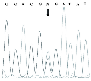 Figure 2. Sequencing result of the promoter region of the SPP2 gene in the index subject of the pedigree which showed a heterozygous C/T mutation
