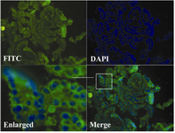 Figure 3. Immunofluorecense staining of sortilin 1 in ovarian carcinoma tissue (T15) using rabbit anti-sortilin 1 polyclonal antibody. The enlarged part clearly shows the cell surface expression of sortilin 1. The figure represents one experiment out of seven