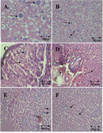Figure 2. Cytological changes during preneoplastic lesion induction and after treatment with Pt-AZT and AT in rats’ liver (H&E staining method). A and B) rat liver with malignant cells. The arrows show the enlarged nucleuses of preneoplastic cells (original magnification 400× in A and 100× in B); C and D) rat liver after treatment with Pt- AZT. The arrows show disrupted nucleus (karyolysis) that is the sign of apoptosis in slide D) arrows also show necrosis and hemorrhage in some parts (original magnification 100×); E and F) rat liver treated with AZT. Arrows show karyolysis and pyknosis, also necrosis and hemorrhages are seen in some parts (original magnification 100×)