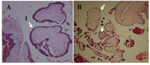 Figure 1. H&E staining of hydatidiform mole. A) CHM characterized by, 1: hydropic villi with circumferential trophoblastic hyperplasia ×100 B) PHM characterized by, 1: hydro-pic and 2: fibrotic villi with focal mild trophoblastic hyperplasia ×100