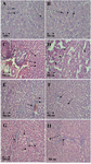 Figure 1. Cytological changes during preneoplastic lesion induction and after treatment with Pt-AZT and AT in rats’ liver (H&E staining method). A and B) rat liver with malignant cells. The arrows show the enlarged nucleuses of preneoplastic cells (original magnification 400× in A and 100× in B); C and D) rat’s liver after treatment with Pt- AZT. The arrows show disrupted nucleus (karyolysis) which is the sign of apoptosis in D slide, arrows also show in some parts necrosis and hemorrhage (original magnification 100×); E and F) rat’s liver treated with AZT. Arrows show karyolysis and pyknosis, also necrosis and hemorrhages are seen in some parts (original magnification 100×); G and H) normal rat’s liver treated with AZT and Pt-AZT, respectively. There were no preneoplastic lesions in some parts and there were some necrosis and hemorrhage (original magnification 100×). 