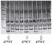 Figure 1. PCR-RFLP pattern of MTHFR C677T polymorphism di-gested with Hinf1 restriction enzyme.