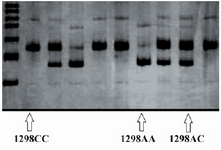 Figure 2. PCR-RFLP pattern of MTHFR A1298C polymorphism di-gested with Mbo II restriction enzyme.