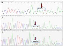 <p>Figure 2. The Sanger Sequencing results. A) The electropherogram of the patient sample shows one adenine nucleotide insertion in a homozygous manner. B, C) The electropherogram of the father and mother samples, respectively. The demonstrated disarrangement results from one &nbsp;adenine nucleotide insertion in a heterozygous manner.</p>
