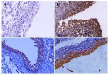 <p>Figure 3. Detection of ROR1 expression in normal and bladder cancer tissues by immunohistochemistry (IHC). Anti-ROR1 mouse monoclonal antibody (5F1-B10), mouse IgG isotype, and anti-beta actin antibodies were used as primary antibody. EnVision detection system (BioGenex, United States) was employed for signal detection and Mayer&rsquo;s hematoxylin was used for counterstaining. A) Bladder carcinoma tissue and isotype control antibody, B) Bladder carcinoma tissue and anti-beta actin antibody, C) Normal bladder tissue and 5F1-B10 antibody, D) Bladder carcinoma tissue and 5F1-B10 antibody (Original magnification, &times;50).</p>