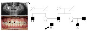 <p>Figure 1. Pedigree of A family. Panoramic radiograph and the clinical photograph of the proband.</p>