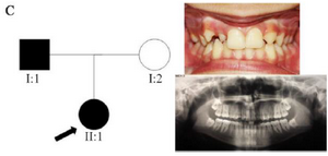 <p>Figure 3. Pedigree of C family. Panoramic radiograph and the clinical photograph of the proband.</p>