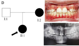 <p>Figure 4. Pedigree of D family. Panoramic radiograph and the clinical photograph of the proband.</p>