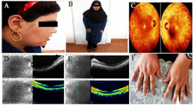 <p>Figure 2. Clinical symptoms of BBS proband. Funduscopy (A) and OCT (B and C) of both right and the left eyes of the affected case. Clinical features of proband (D and E) without polydactyly (F).</p>