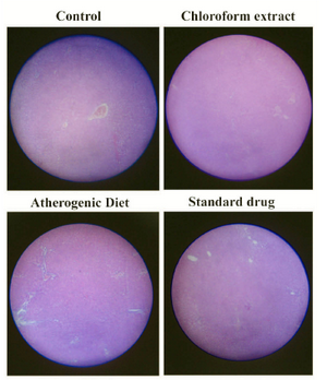 Figure 3. Histopathological sections of liver
(Atherogenic- perivenular inflammatory change, fatty lobular infiltration)
