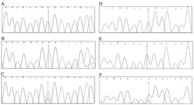 <p>Figure 2. Sequencing results. Polymorphism rs2013162. A) CC homozygote (wild), B) AA homozygote (variant), C) CA heterozygote. Polymorphism rs2235375, D) CC homozygote (wild), E) GG homozygote (variant), F) CG heterozygote.</p>
