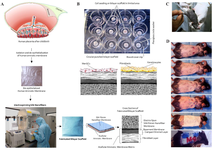 <p>Figure 1. Steps of preparation and application of wound dressing in diabetic mice. A) Human placenta being surrounded by two layers of the amniotic membrane and chorion. The human amniotic membrane was separated from amniochorionic membrane, de-epithelialized and freeze-dried. Nano-fibers were electro-spun on the basement membrane side of de-epithelized HAM by pumping silk fibroin solution by high voltage transmission. The schematic cross section of bilayer scaffold was showed. B) Cultivation of MenSCs and/or fibroblasts/keratinocytes for seeding on bilayer scaffold through sequential steps as mentioned in earlier report. C) Induction of diabetes by streptozotocin in C57BL/6 mice, D) Different parts of intervention (steps 1 to 6). 1) induction of full-thickness skin wounds, 2) wound dressing implantation, 3 and 4) splinting toward 5 and 6) wound dressing and bandage.</p>