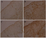 <p>Figure 4. Evaluation of PHA functionality using IHC. The targeting of vimentin antigen with monoclonal anti-vimentin antibody on MDA-MB-231 tumor cells on chick embryo CAM was examined. Negative control without anti-vimentin antibody (A). Test sample including anti-vimentin antibody to assess PHA activity (B). Negative control using a commercial conjugate (C). Positive control with a commercial conjugate (D).</p>