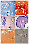 Figure 7. Histochemical examination of tissue constructs cul-tured in biomimetic bioreactor and culture flask. Arrow in-dicate newly formed matrix (magnification of A, B, C, E and E 20×, for D 5×). A) After 2 weeks cultivation of alginate/ chondrocyte sheet in biomimetic bioreactor, newly secreted matrix with lacuna formation around chondrocytes as shown by alcian blue staining. Nuclei appear red. B) After 2 weeks cultivation of anatomic shaped of alginate/chondrocyte in biomimetic bioreactor. The cationic dye safranin O binds to stained glycosaminoglycan intensely red.  C-D) The histolo-gical examination of the alginate/chondrocyte beads cultured in bioreactor with toluidine blue revealed that it contained a cartilage-like matrix that accumulated within the lumen of clusters of round cells and chondron were surrounded by remnants of territorial matrix. E-F) Control group (static cul-ture in culture flask) when stained with safranin O/ hemato-xylin and hematoxylin/eosin, respectively