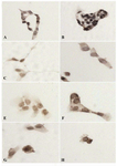 Figure 7. Subcellular localization of p53 in DU145 cells. DU145 cells were seeded in 96 wells plates overnight and then treated without or with antineoplastic and LiCl alone or in combination for 48 hr. A) control (untreated); B) LiCl 
20 mM; C) Doxorubicin 230 M; D) Doxorubicin 230 M + LiCl 20 mM E) Etoposide 18 M F) Etoposide 18 M + LiCl 20 mM G) Vinblastine 5 M H) Vinblastine 5 M+LiCl 
20 mM. Results showed strong nuclear p53 immunostaining in the presence of LiCl alone compared to other conditions
